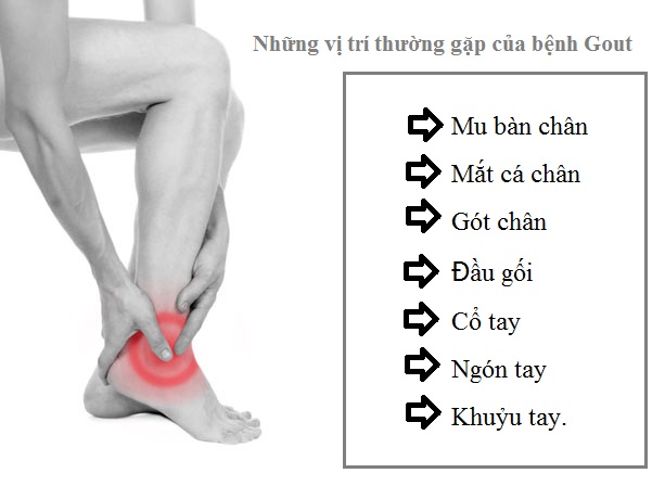 các vị trí bị bệnh Gút tấn công