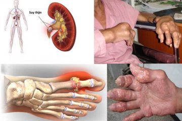 Tác hại của bệnh Gout và những phương thuốc hiệu nghiệm cho căn bệnh này